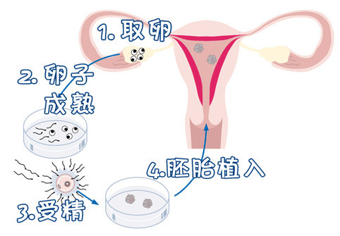 正规拉拉供卵代孕咨询